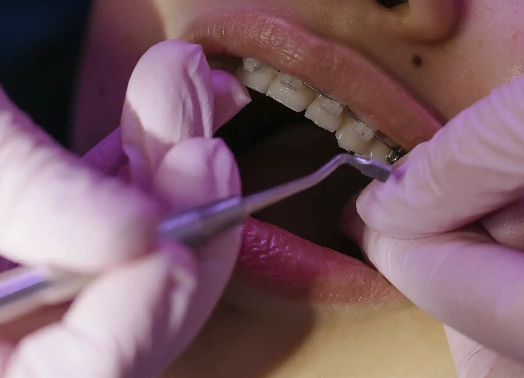Brackets metálicos tradicionales colocados en joven paciente durante tratamiento en Querétaro