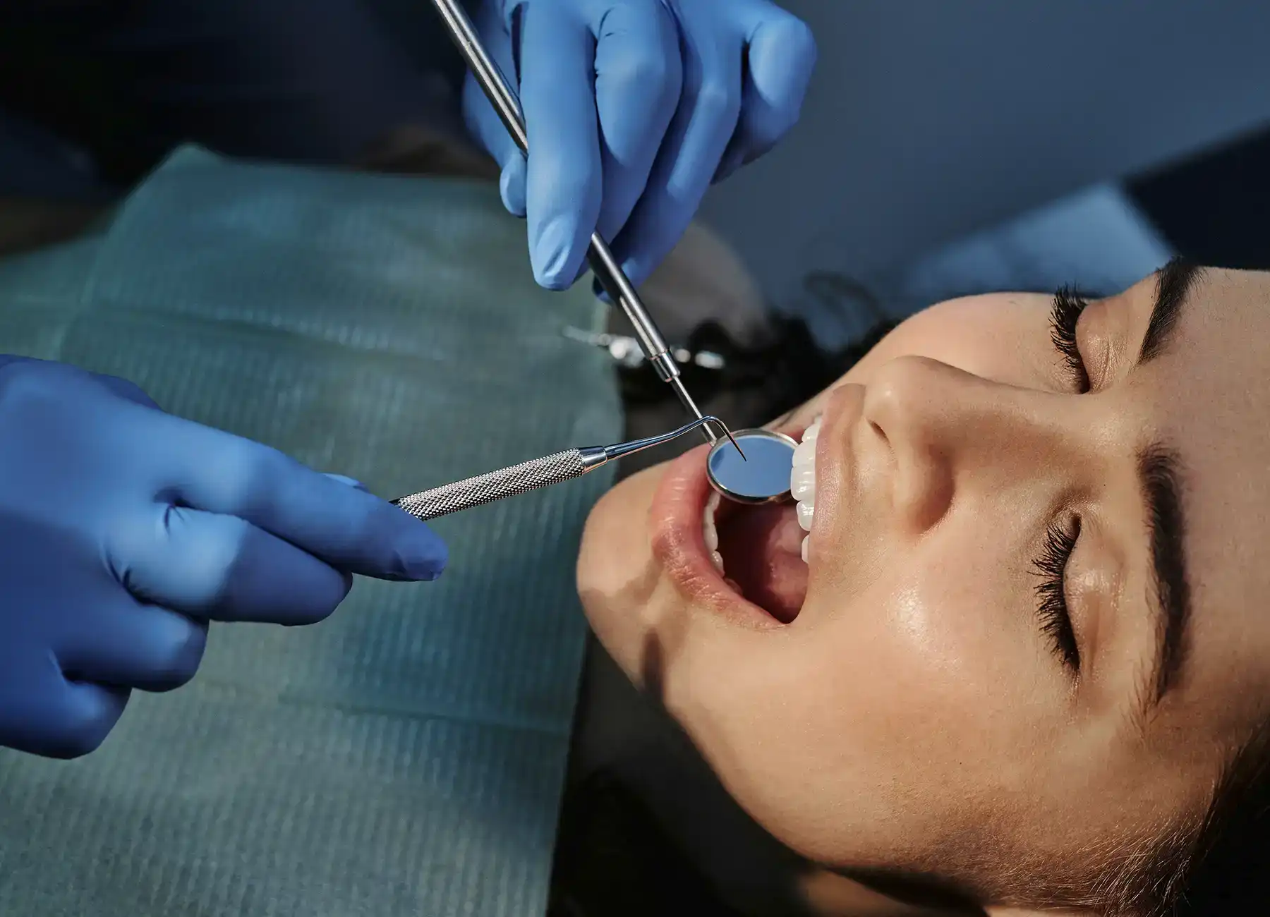 Paciente con boca abierta mostrando brackets linguales colocados una opción estética al pensar qué tipo de brackets es mejor para ti