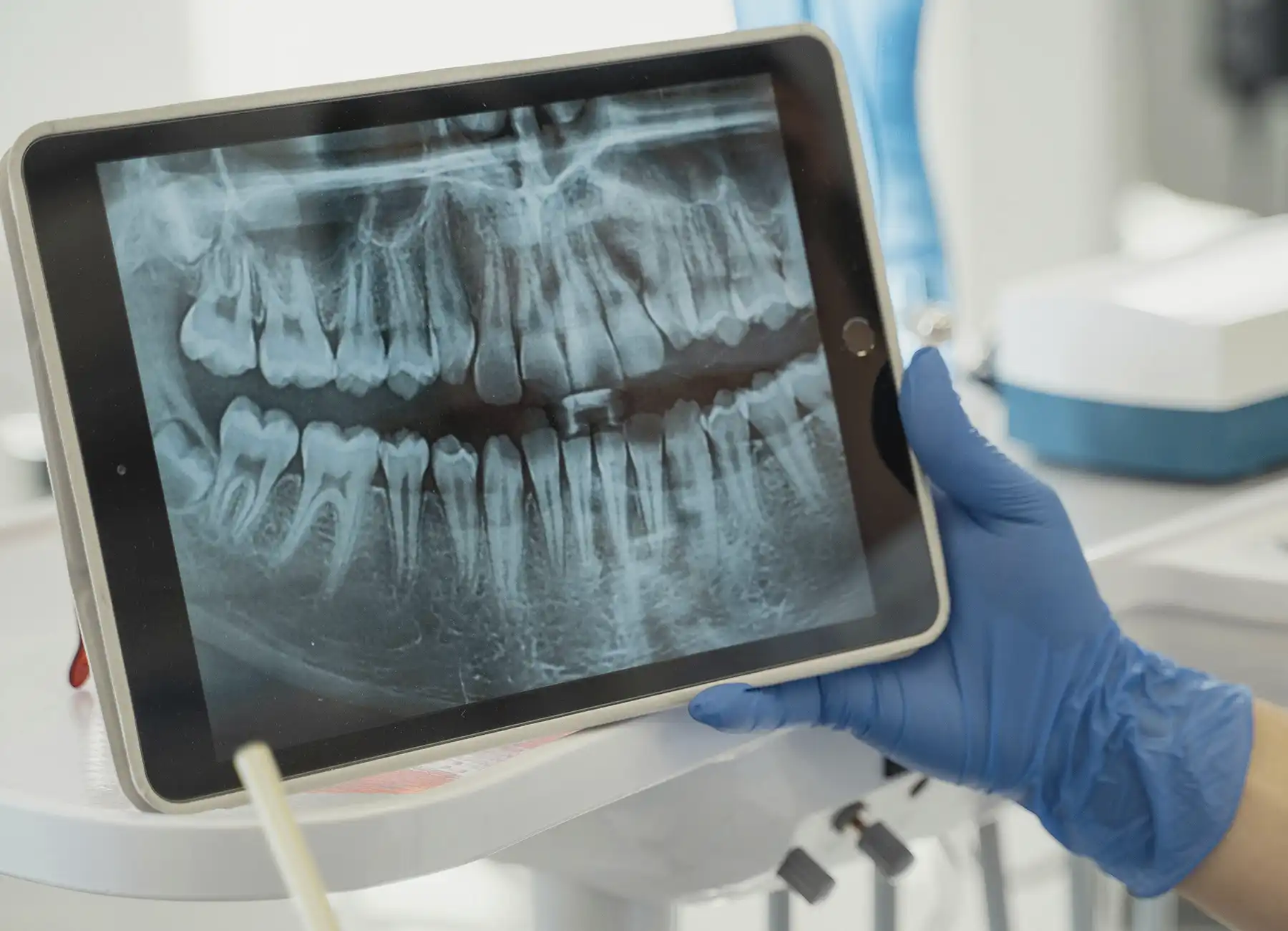 Radiografía dental de paciente que rompió un bracket y fue atendido fuera del tiempo regular