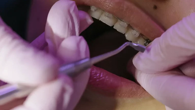 ortodoncista-ajustando-brackets-autoligables-durante-una-revision