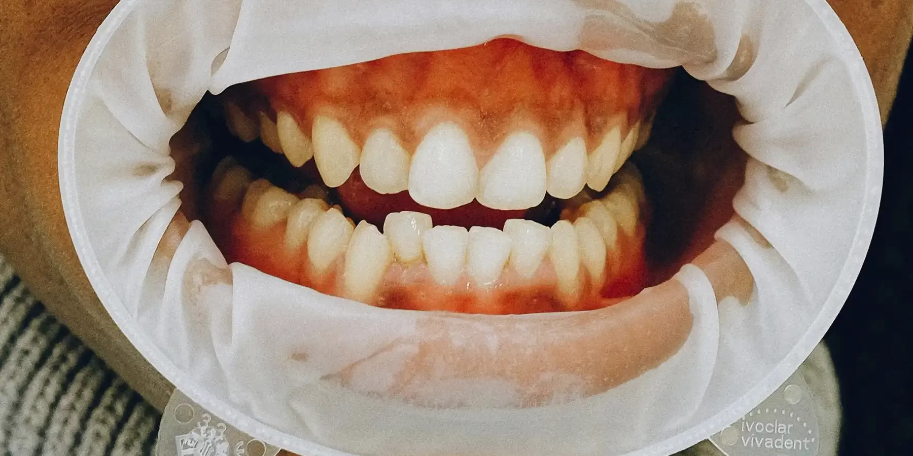 ortodoncista-evaluando-sonrisa-con-dientes-salidos-en-corregidora