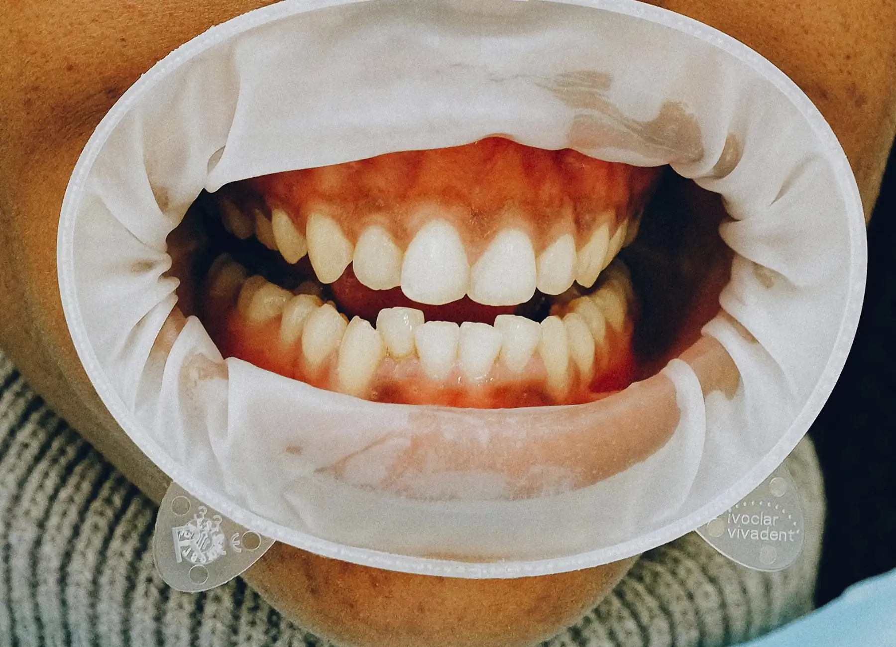 sonrisa-con-dientes-montados-antes-de-iniciar-ortodoncia