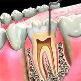endodoncia y tratamientos especializados para pacientes en queretaro