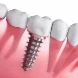 planificacion e instalacion de implantes dentales con tratemiento para pacientes en queretaro